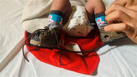 Join the Movement: Celebrate Clubfoot Day Today!